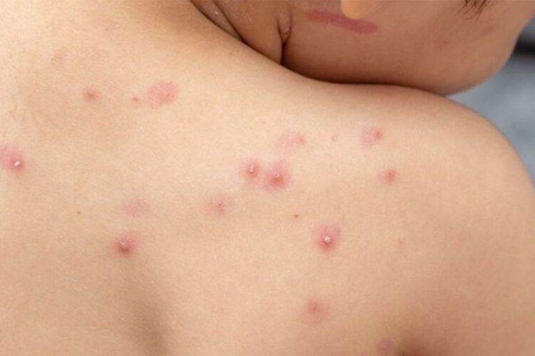  Monkeypox: Ceará confirma primeiro caso da doença em criança.