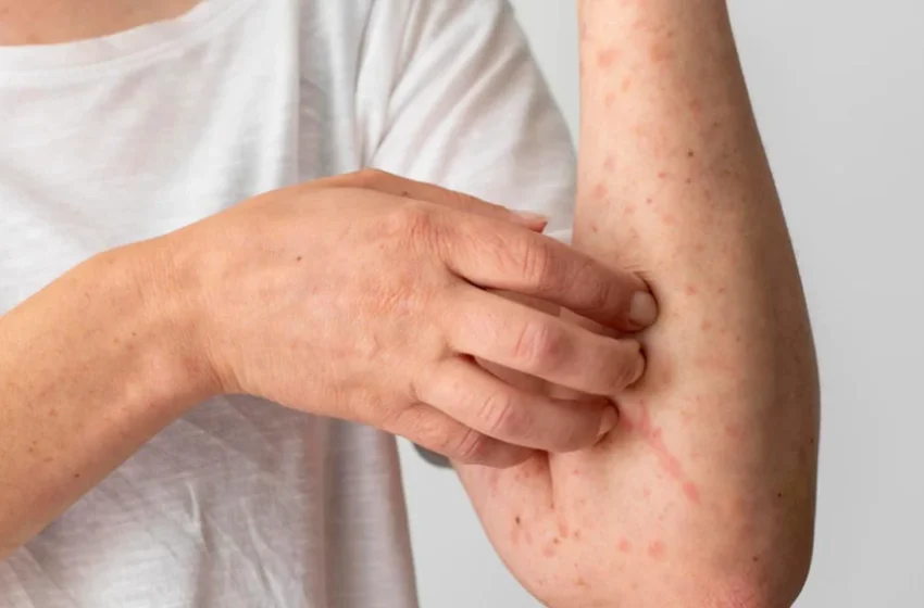  Monkeypox: sem previsão de receber vacina, Ceará confirma 380 casos em 3 meses.